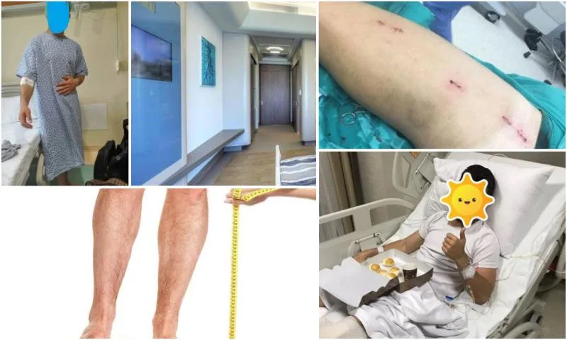 Bacak Uzatma Ameliyatı - Leg Extension Surgery