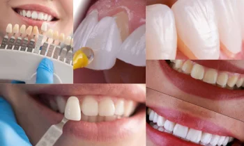 Ön Dişlerde Estetik Dolgu Nedir?