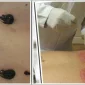Tıbbi Sülük Tedavisinin Faydaları