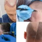 Saç Ekimi - Hair Transplant Nedir?